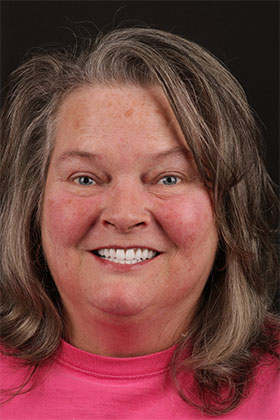 Bright and natural smile of a patient after receiving implant-supported dentures.